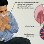 1200px-Depiction_of_a_tuberculosis_patient